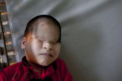 Agent Orange Victims Haunting Photos Of The Unpunished War Crimes Of U S In Vietnam War