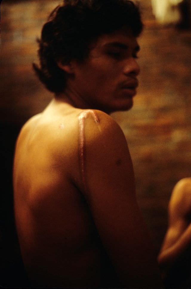 This prisoner had battery acid poured on his shoulder by Somoza's National Guard, Managua, 1978